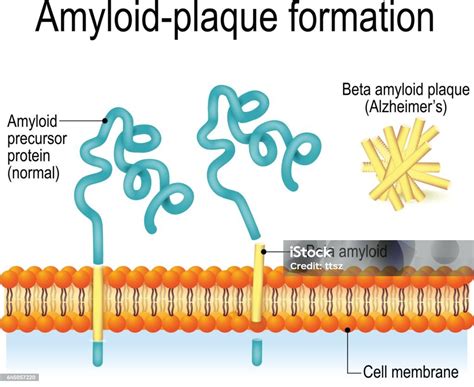 amyloid beta plaque|Amyloid Beta Peptide .